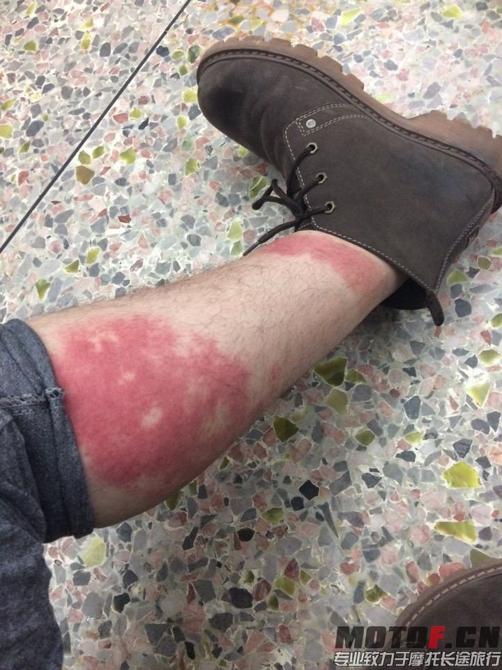 白白净净的腿被熏成这样。。大家快给我想想办法，防止悲剧重演。